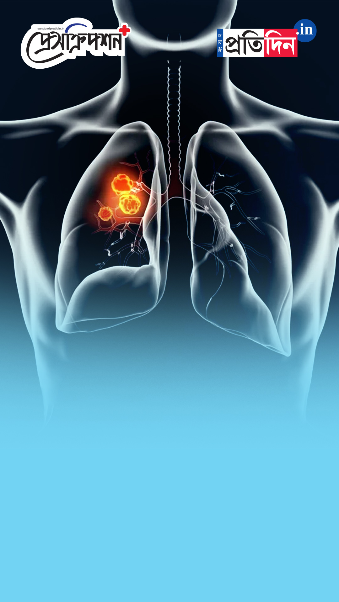 World Lung Cancer Day | Prescription Plus | ধূমপান না করলেও হতে পারে ফুসফুসের ক্যানসার!